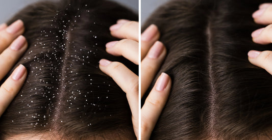 The Complete Guide to Scalp Health: Why It Matters and How to Achieve It