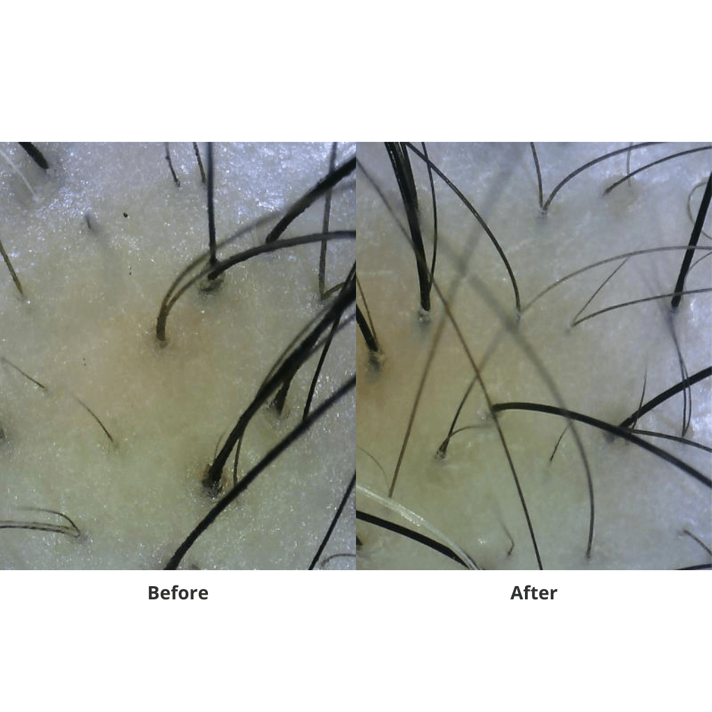 juliArt Hair Loss With Dry Scalp ECHO System - MANEPRINT
