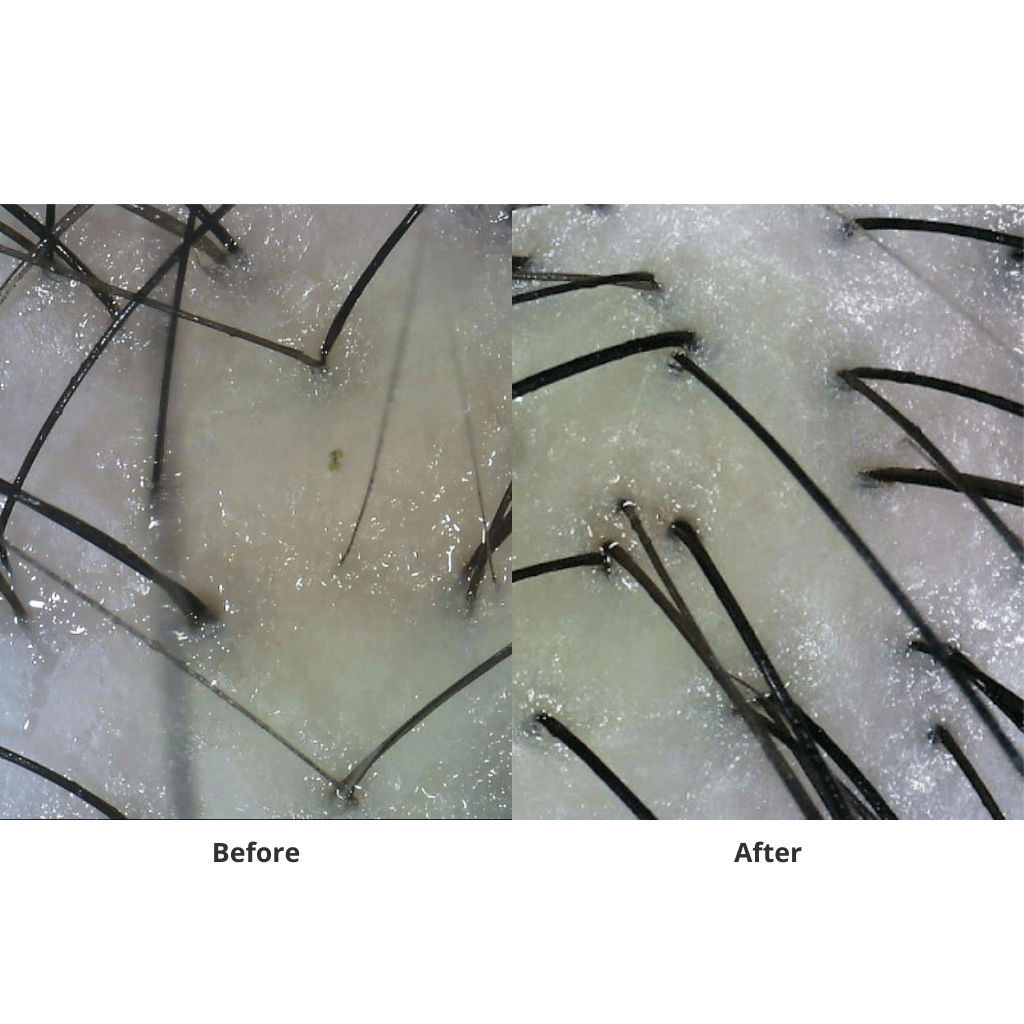 juliArt Hair Loss With Oily Scalp ECHO System - MANEPRINT