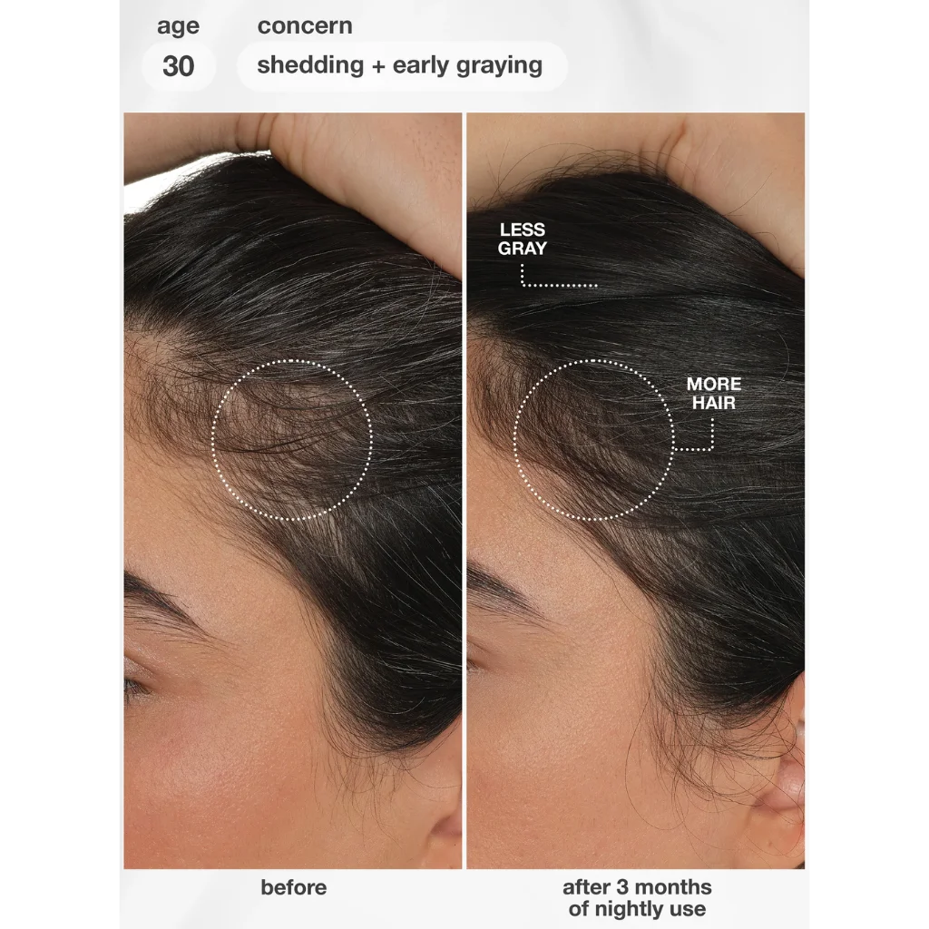 Before-and-after hair density comparison showing a person's scalp and hairline at age 30, with text noting 'shedding + early graying' and 'less gray, more hair' after 3 months of nightly use. MANEPRINT